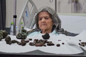 GÖRENLER ŞOK OLDU: 92 YAŞINDAKİ KADININ MİDESİNDEN VE BAĞIRSAKLARINDAN 35 ZEYTİN, 28 HURMA ÇEKİRDEĞİ İLE 5 TAŞ ÇIKTI ZONGULDAK BEUN HASTANESİ GENEL CERRAHİ ANA BİLİM DALI DOKTOR ÖĞRETİM ÜYESİ İLHAN TAŞDÖVEN: "BU TÜR ÇEKİRDEKL