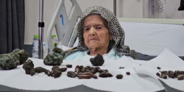 GÖRENLER ŞOK OLDU: 92 YAŞINDAKİ KADININ MİDESİNDEN VE BAĞIRSAKLARINDAN 35 ZEYTİN, 28 HURMA ÇEKİRDEĞİ İLE 5 TAŞ ÇIKTI ZONGULDAK BEUN HASTANESİ GENEL CERRAHİ ANA BİLİM DALI DOKTOR ÖĞRETİM ÜYESİ İLHAN TAŞDÖVEN: "BU TÜR ÇEKİRDEKL